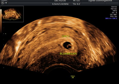 Scanningsbillede uge 5 - Signes jordemoder-og scanningsklinik